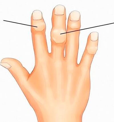 Κόμβοι Heberden και Bouchard στις μεσοφαλαγγικές αρθρώσεις με οστεοαρθρίτιδα