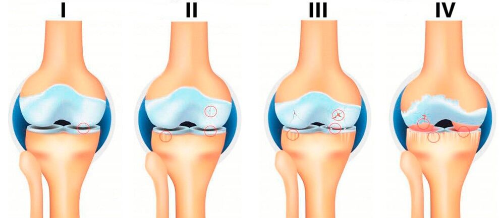 Στάδια οστεοαρθρίτιδας