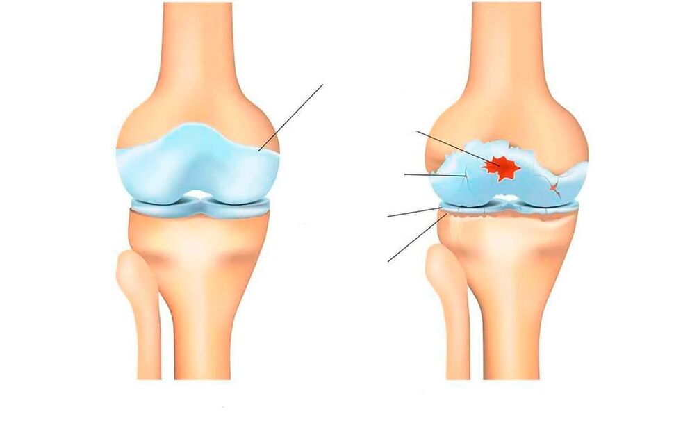 υγιής άρθρωση και για την οστεοαρθρίτιδα